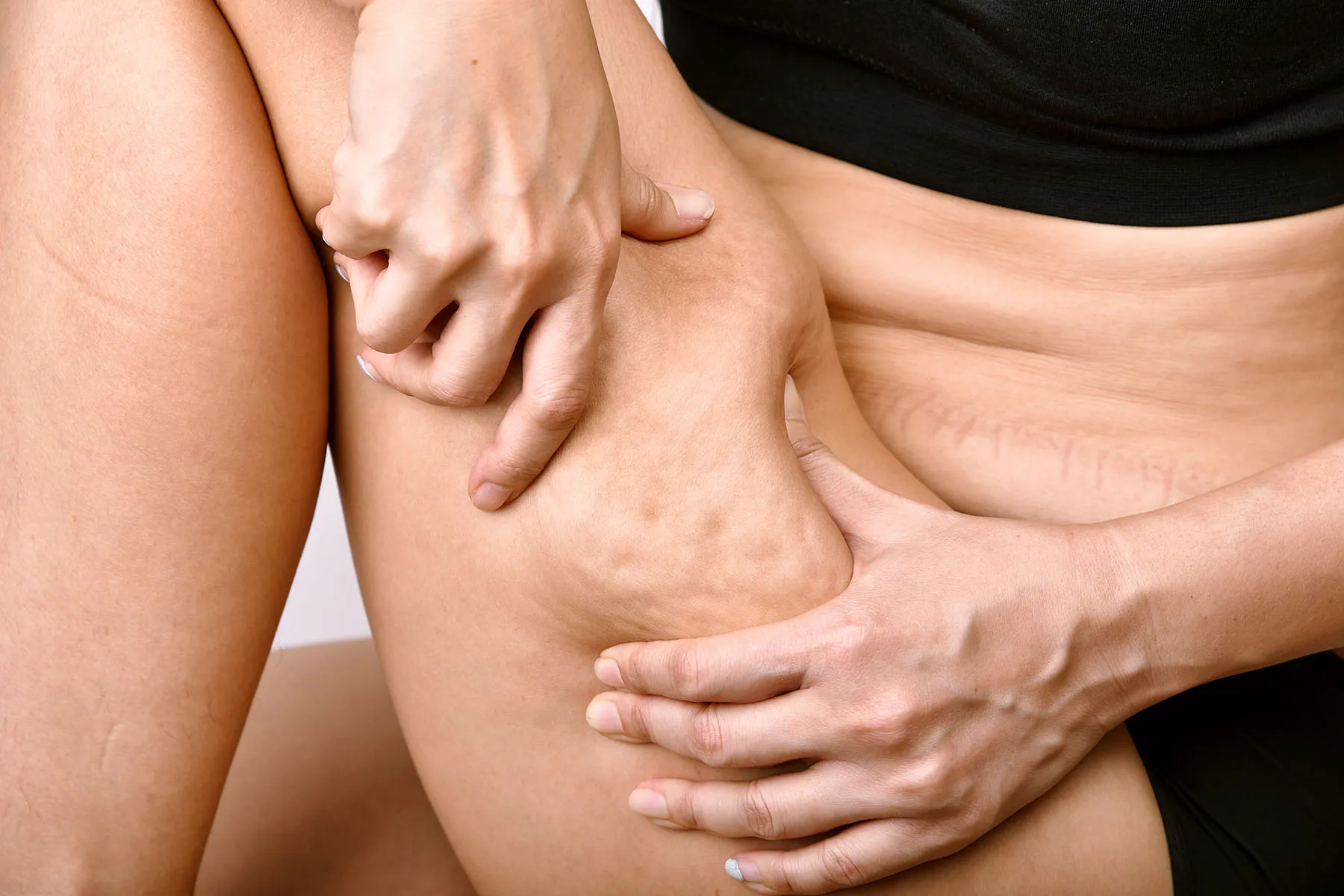 Why Cellulite Appears: Unraveling Causes Beyond Weight and Genes